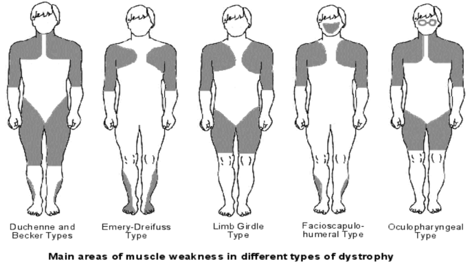 Edmd.png - Muscular Dystrophy, Transparent background PNG HD thumbnail