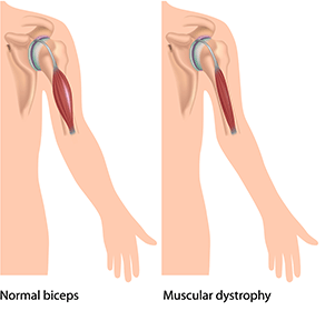 Muscular Dystrophy - Muscular Dystrophy, Transparent background PNG HD thumbnail