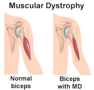 Muscular Dystrophy, Mayopathy - Muscular Dystrophy, Transparent background PNG HD thumbnail