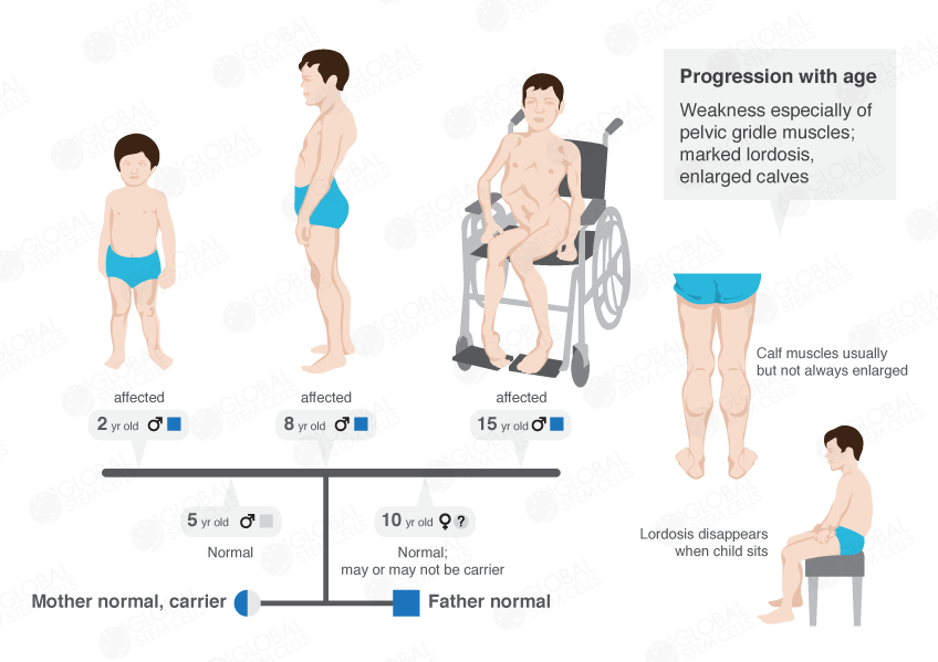 What Is Muscular Dystrophy ? - Muscular Dystrophy, Transparent background PNG HD thumbnail
