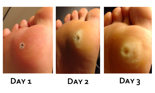 Best Verruca Treatment, How To Heal Your Verruca, Best Plantar Wart Removal - Planters Wart, Transparent background PNG HD thumbnail