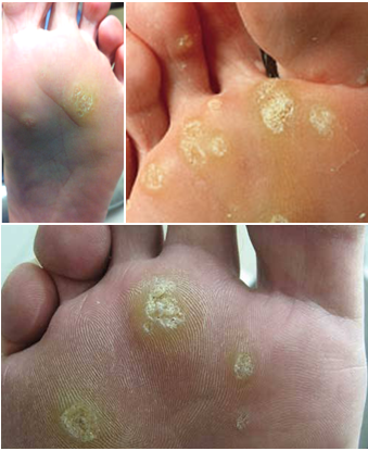 Young plantar wart images,gel