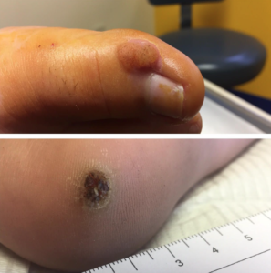 Plantar warts are a special t