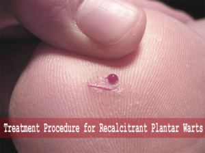 Treatment Procedure For Recalcitrant Plantar Warts - Planters Wart, Transparent background PNG HD thumbnail