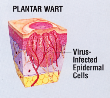 Warts Are Caused By A Dna Virus In The Family Human Papilloma Virus (Hpv). Hpv That Infects The Foot Should Not Be Confused With The Types That Cause Hdpng.com  - Planters Wart, Transparent background PNG HD thumbnail