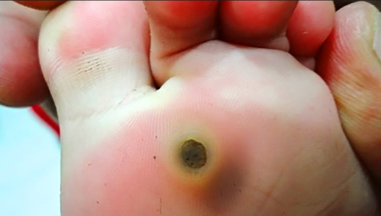 What are Plantar Warts?