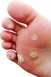 You can prevent the spread of warts by avoiding direct contact, avoidwalking barefoot, changing shoes and socks daily and keeping your feetclean and dry., Planters Wart PNG - Free PNG