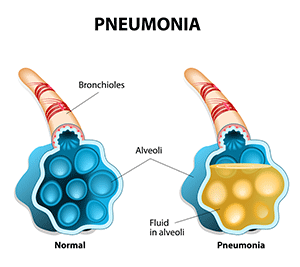 . PlusPng.com Lobar pneumonia