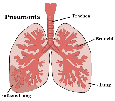 ICD-10 Pneumonia Vignette