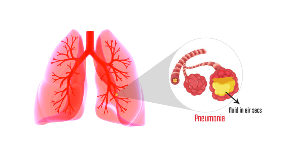 Pneumonia Png Hdpng.com 1030 - Pneumonia, Transparent background PNG HD thumbnail
