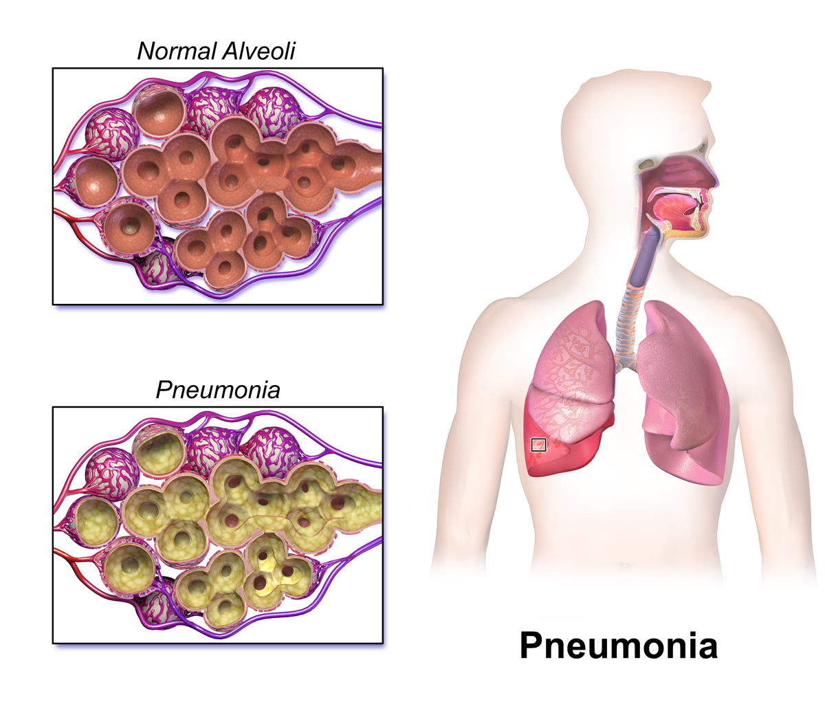 File:Blausen 0994 Pneumonia.png, Pneumonia PNG - Free PNG
