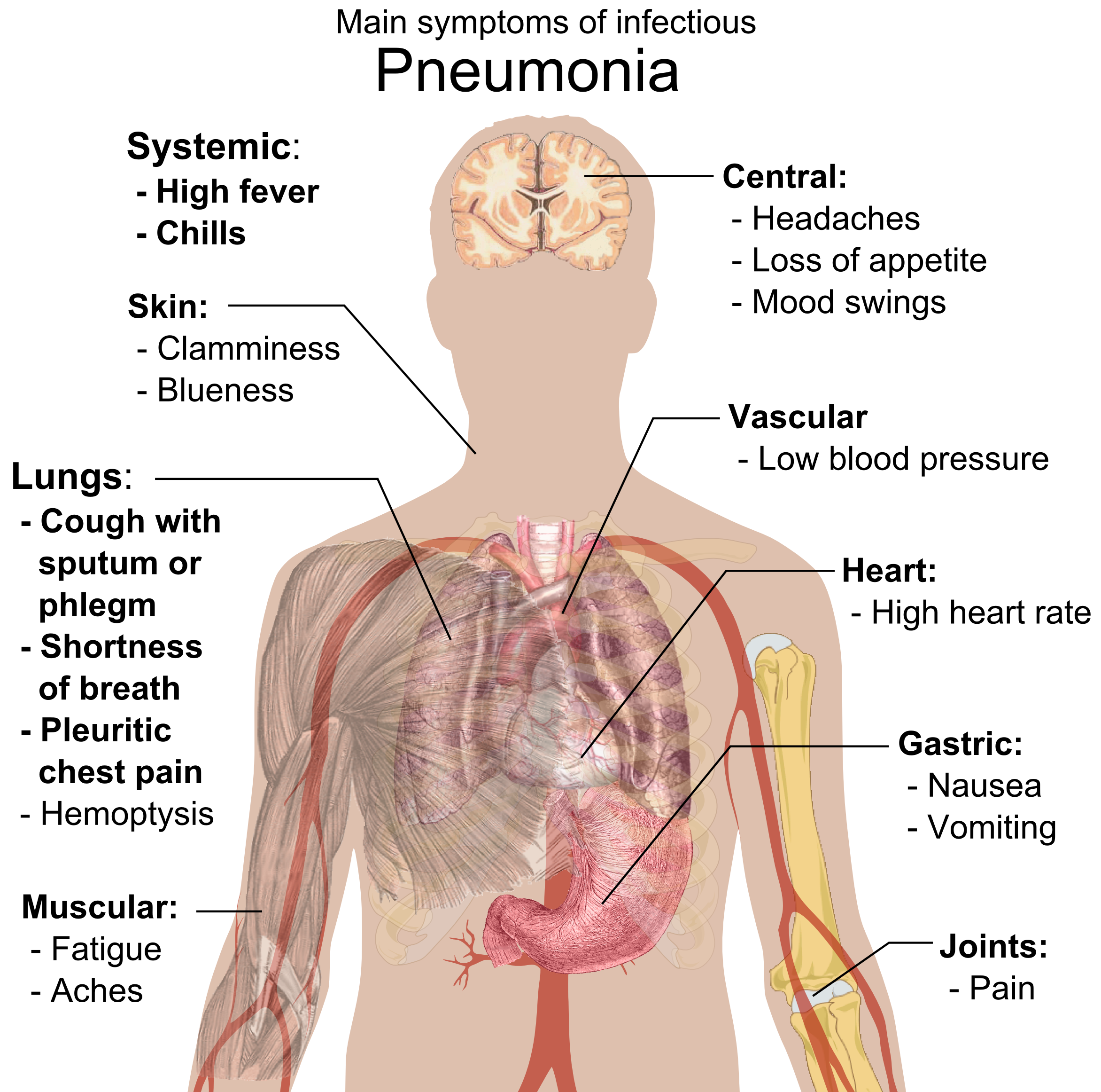 File:main Symptoms Of Infectious Pneumonia.png - Pneumonia, Transparent background PNG HD thumbnail