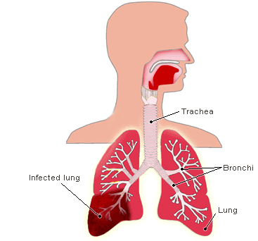 Icd 10 Pneumonia Vignette - Pneumonia, Transparent background PNG HD thumbnail