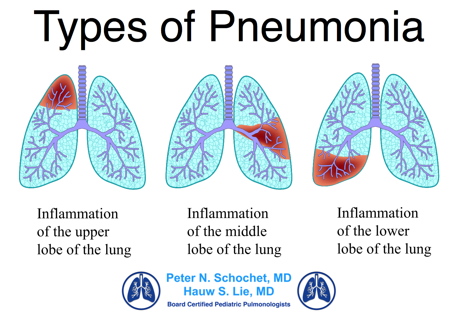 ICD-10 Pneumonia Vignette