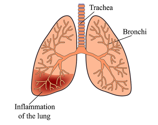 Pneumonia- copd