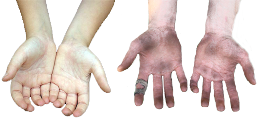 The U201Cfinger Test For Donenessu201D Suggests That By Touching Different Fingers With Your Thumb, The Fleshy Part Of The Hand Will Mimic Meat Cooked To Certain Hdpng.com  - Two Hands, Transparent background PNG HD thumbnail