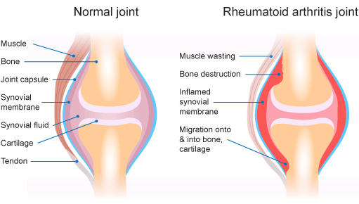 Normal Joint Compared To Rheumatoid Arthritis Joint Diagram - Rheumatism, Transparent background PNG HD thumbnail