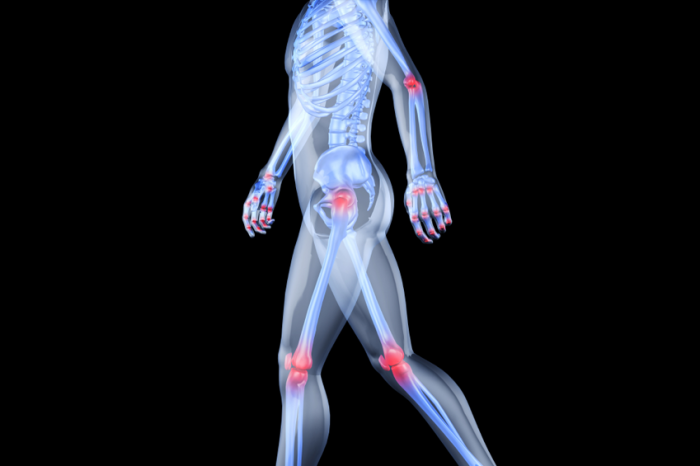 What Is Arthritis? - Rheumatism, Transparent background PNG HD thumbnail