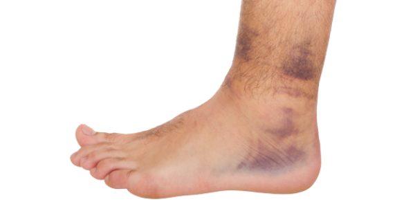 Sprained Ankle Png Hdpng.com 600 - Sprained Ankle, Transparent background PNG HD thumbnail
