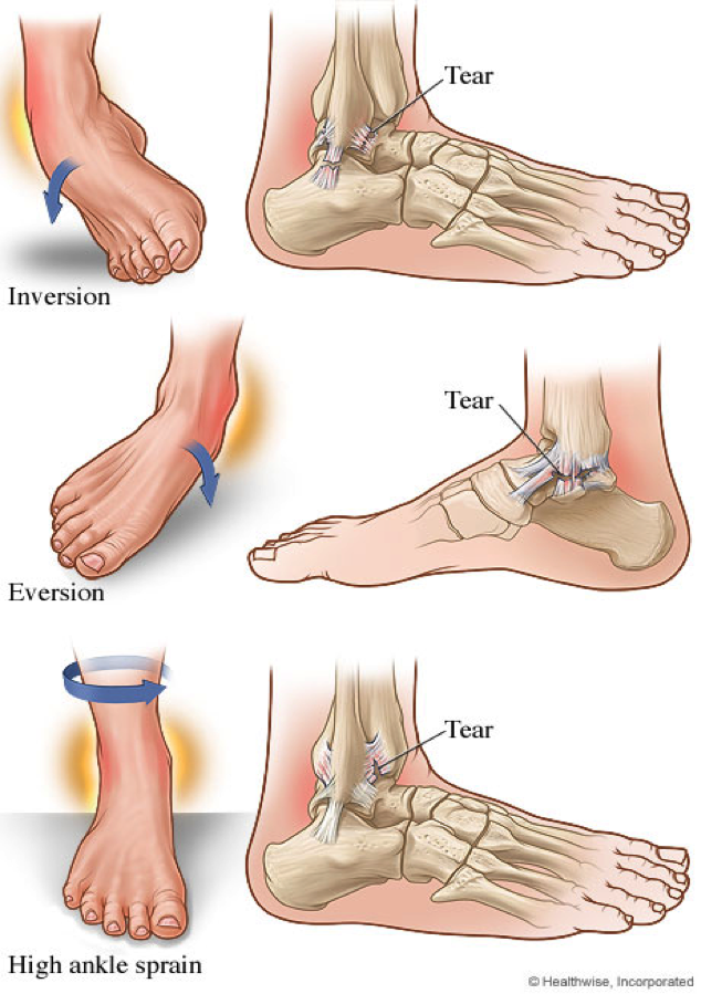 Ankle Injuries And Tennis - Sprained Ankle, Transparent background PNG HD thumbnail