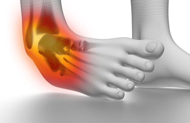Ankle Sprain Inversion Physical Therapy - Sprained Ankle, Transparent background PNG HD thumbnail