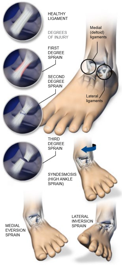 Eversion motion causes medial