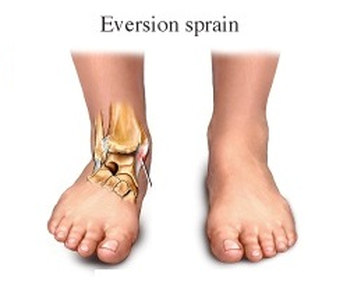 Eversion Motion Causes Medial Ankle Sprain. - Sprained Ankle, Transparent background PNG HD thumbnail