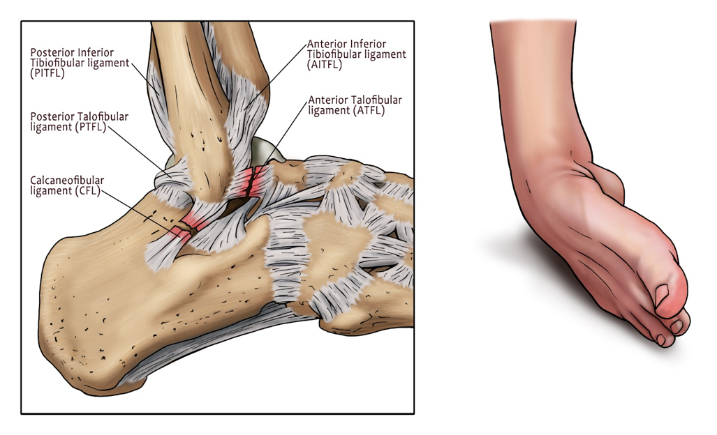 Incorrect Or Delayed Injury Management May Lead To Chronic Ankle Pain, Instability Or Other Biomechanics Problems Affecting Your Knee, Hip And Spine. - Sprained Ankle, Transparent background PNG HD thumbnail