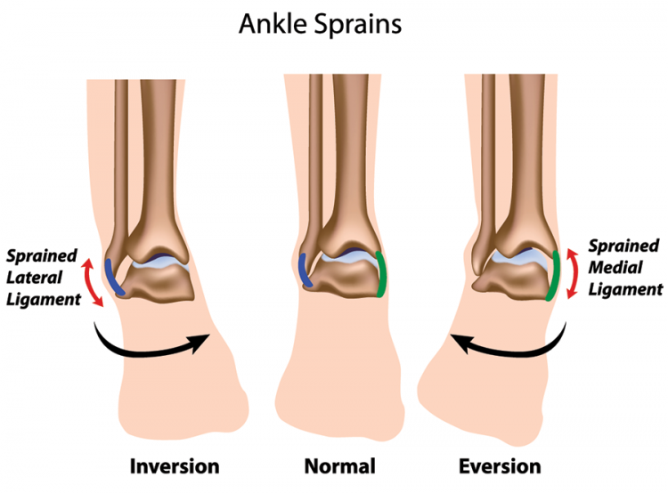 Recovering From An Ankle Injury? - Sprained Ankle, Transparent background PNG HD thumbnail