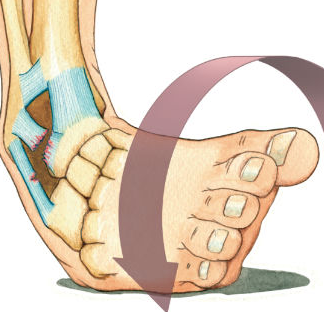 Ankle sprain