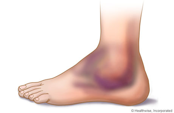 The vast majority of ankle sp