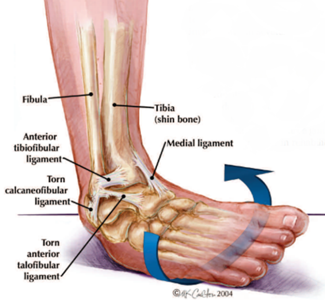 The Vast Majority Of Ankle Sprains Are U0027Inversionu0027 Sprains Meaning That The Affected Ankle Is Turned Inwards Towards The Opposite Foot And The Personu0027S Hdpng.com  - Sprained Ankle, Transparent background PNG HD thumbnail