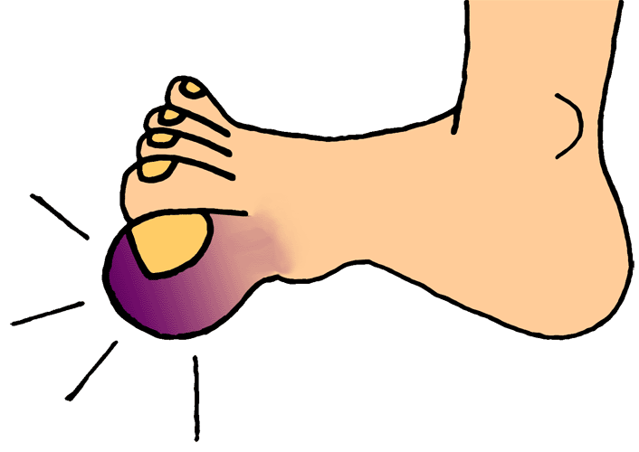 Stub Toe Png - Broken Toe    Foot Problems And Treatment, Transparent background PNG HD thumbnail
