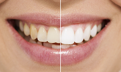 Teeth Whitening Before And After Example - Teeth Smile, Transparent background PNG HD thumbnail