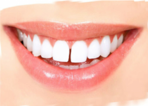 A Tooth Gap U2014 Or U201Cdiastemau201D U2014 Between The Two Front Teeth Can Look Cute On A Youngster, But Most Adults Prefer For Their Teeth To Align Nicely Side By Side. - Tooth Gap, Transparent background PNG HD thumbnail