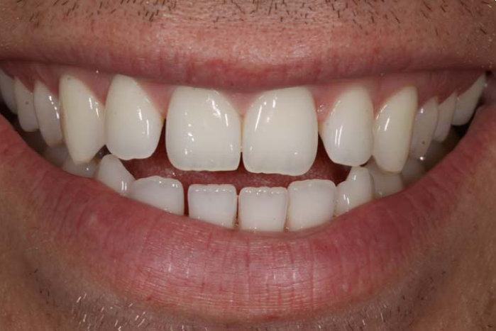 Close The Spaces ( Gaps) Of Upper And Lower Front Teeth 2. Prominent ( Pointy) Canines 3. Flaring Of Upper Teeth 4. The Reverse Smile Line Was Most Evident Hdpng.com  - Tooth Gap, Transparent background PNG HD thumbnail