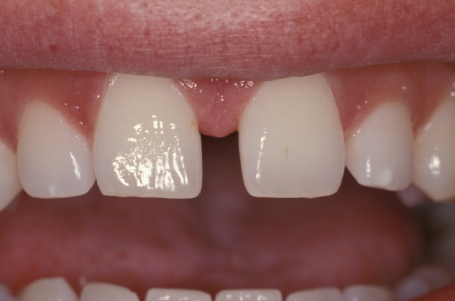 Diastema is a gap between teeth, Tooth Gap PNG - Free PNG