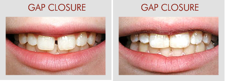 Gap Closure And Missing Tooth Replacement - Tooth Gap, Transparent background PNG HD thumbnail