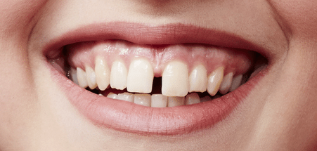 Gap Tooth Smile Plano Tx Cosmetic Dentist - Tooth Gap, Transparent background PNG HD thumbnail