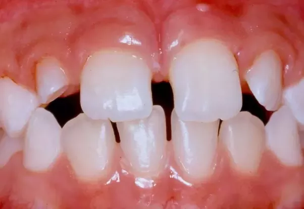 If The Arch Length Is Normal, There Is A Gap In Teeth To Compensate For The Size Of The Teeth. Picture Below - Tooth Gap, Transparent background PNG HD thumbnail
