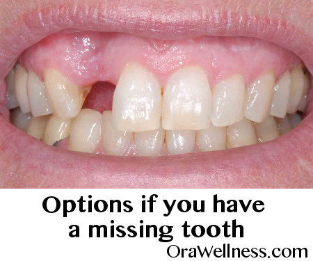 Options If You Have Missing Teeth - Tooth Gap, Transparent background PNG HD thumbnail