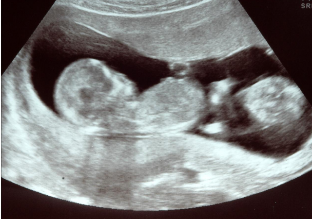 Twin Babies Ultrasound Image.png - Twin Baby, Transparent background PNG HD thumbnail