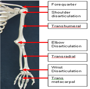 Levels Of Amputation   Upper Limb - Upper Limbs, Transparent background PNG HD thumbnail